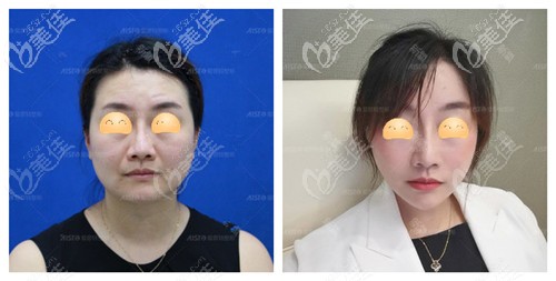 中山愛思特全臉埋線提升案例