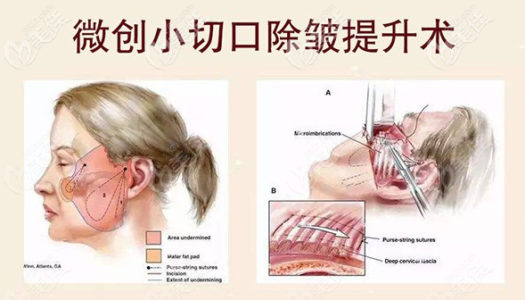 微創(chuàng)小切口除皺術(shù)