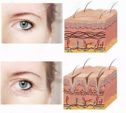 注射嗨體去除眼部皺紋對比照 注射嗨體去除眼部皺紋對比照