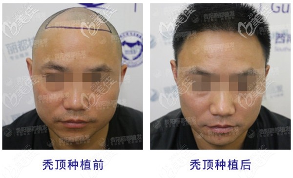 頭頂植發(fā)2500單位效果圖 頭頂植發(fā)2500單位效果圖
