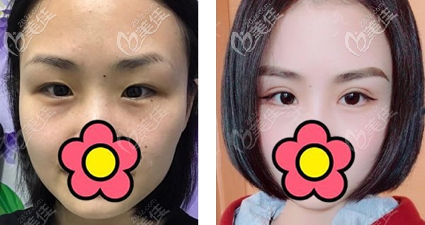 內(nèi)雙可以割雙眼皮嗎 內(nèi)雙可以割雙眼皮嗎