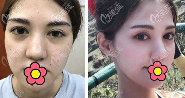 蘭州韓美歪鼻矯正+激光祛斑效果圖 蘭州韓美歪鼻矯正+激光祛斑效果圖