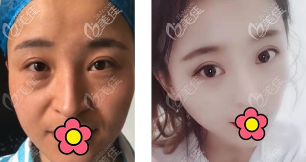 蘭州韓美陽贊生內(nèi)切去眼袋+全臉脂肪填充三個(gè)月恢復(fù)圖 蘭州韓美陽贊生內(nèi)切去眼袋+全臉脂肪填充三個(gè)月恢復(fù)圖