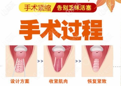 縮陰手術(shù)操作步驟 縮陰手術(shù)操作步驟