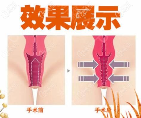 縮陰術(shù)后效果對(duì)比 縮陰術(shù)后效果對(duì)比