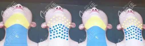 熱瑪吉下頜緣做的大概位置