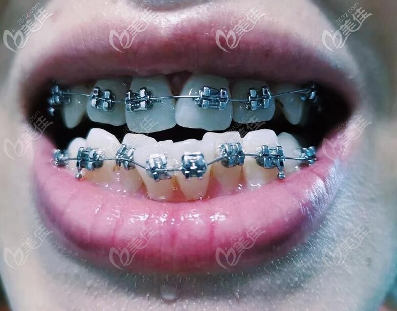 牙齒擁擠不齊矯正前樣子 牙齒擁擠不齊矯正前樣子