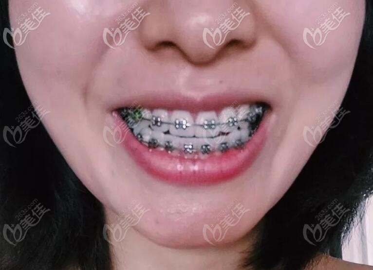 雖然美國damon自鎖托槽的價(jià)格比國產(chǎn)的貴些，但感覺真的好