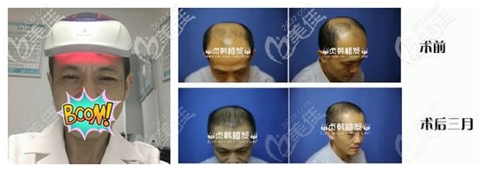 為什么植發(fā)醫(yī)生不植發(fā)?來(lái)聽(tīng)聽(tīng)桂林貞韓的覃堅(jiān)醫(yī)生是如何回復(fù)的!