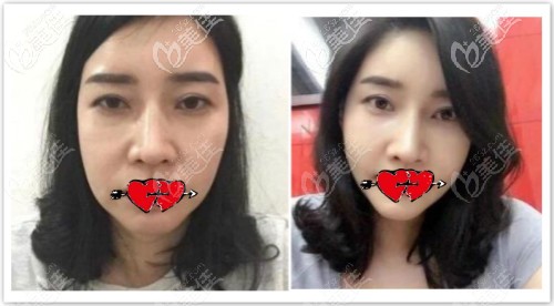 做面部微創(chuàng)筋膜懸吊提升兩年效果前后對比