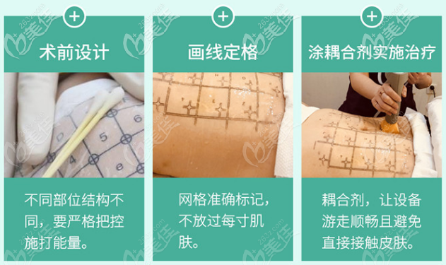 熱瑪吉去除妊娠紋治療過(guò)程