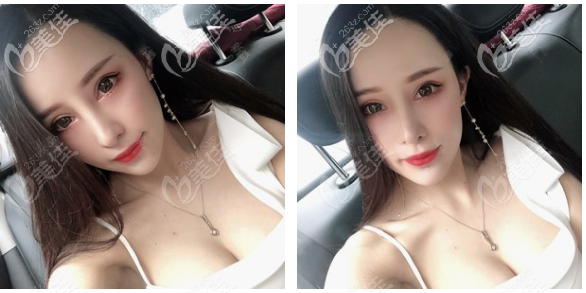 為什么說隆胸就選佛山美萊?因?yàn)槲艺以横t(yī)生做的假體豐胸效果太贊了