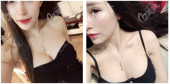 佛山美萊曾昂豐胸案例一個(gè)月效果圖