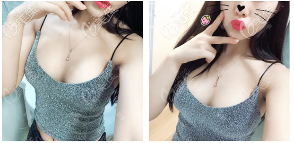 佛山美萊曾昂豐胸術(shù)后12天反饋