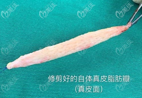 自體真皮瓣組織