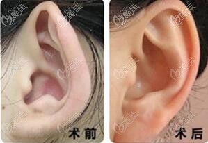 小孩招風(fēng)耳矯正術(shù)后一年效果圖
