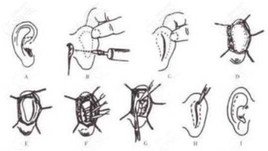 招風(fēng)耳矯正手術(shù)方法操作過(guò)程圖解