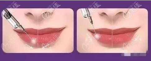 玻尿酸豐唇位置