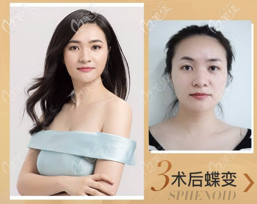 廣州美萊面部熱瑪吉術(shù)后效果