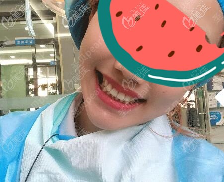 牙齒反彈還有做二次矯正的必要嗎?安利我凸嘴再正畸后的感受