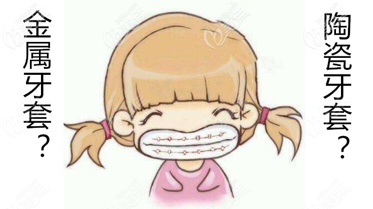 戴牙套選擇那種比較好 戴牙套選擇那種比較好