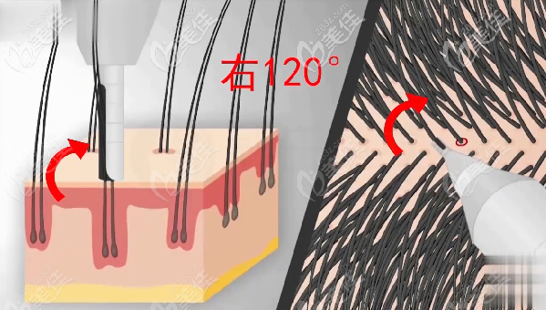 不剃發(fā)植發(fā)采用左180°右120°雙向旋轉(zhuǎn)的方式提取毛囊