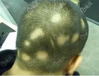 什么是斑禿，斑禿的樣子
