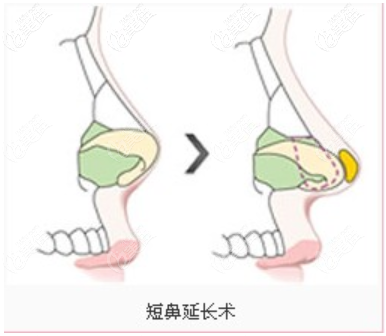 短鼻延長(zhǎng)圖