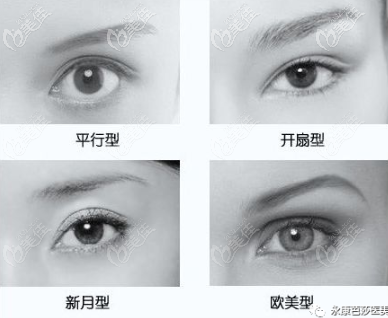 永康芭莎雙眼皮類型 永康芭莎雙眼皮類型