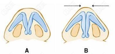 肥厚鼻尖矯正術(shù)前術(shù)后對(duì)比示意圖