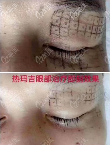 眼部熱瑪吉即刻效果