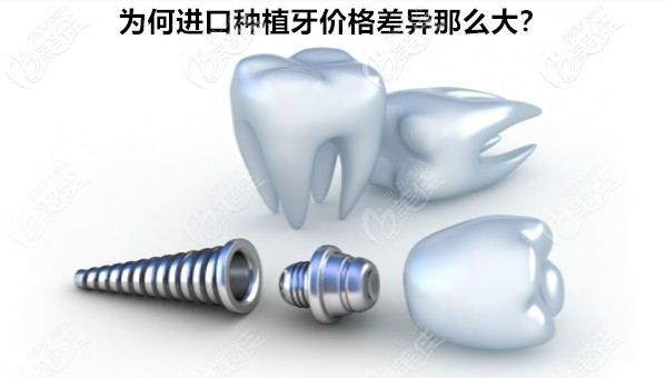進(jìn)口種植牙價(jià)格為什么差距那么大呢