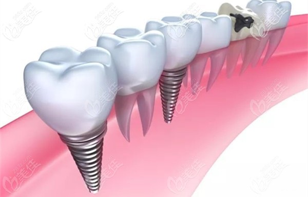 更新一份歐美品牌的進(jìn)口種植牙價(jià)格表