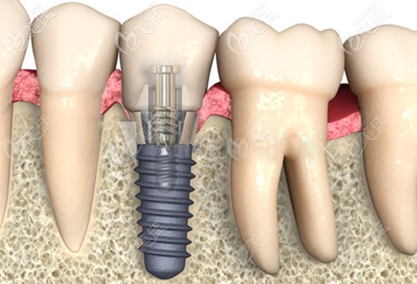種植體在牙槽骨中的示意圖