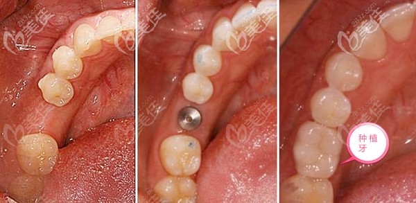 種植牙前后對(duì)比