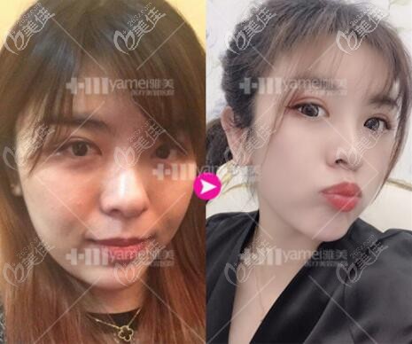 體驗第四代熱瑪吉前后對比照 體驗第四代熱瑪吉前后對比照