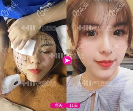 進行熱瑪吉體驗過程中 進行熱瑪吉體驗過程中