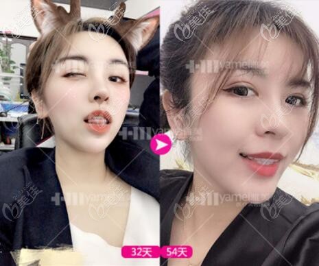 做完第四代熱瑪吉一個月后的效果 做完第四代熱瑪吉一個月后的效果