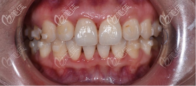 牙齒天包地做隱適美矯正效果圖流出,這變化你愛(ài)了嗎