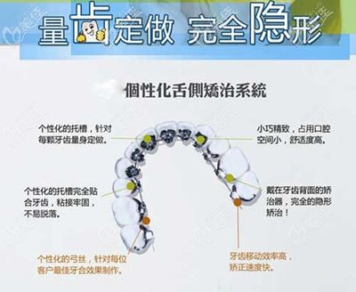 舌側(cè)矯正的優(yōu)勢(shì) 舌側(cè)矯正的優(yōu)勢(shì)