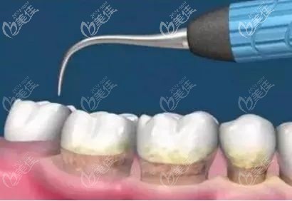 齦下刮治 齦下刮治