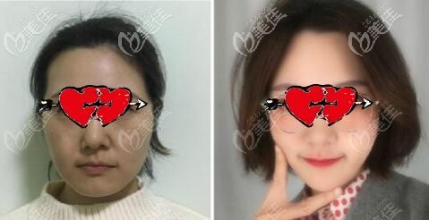 成都銅雀臺(tái)熱瑪吉全臉20天效果對(duì)比 成都銅雀臺(tái)熱瑪吉全臉20天效果對(duì)比