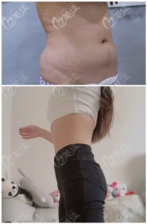 青島華顏美張慶吸脂案例