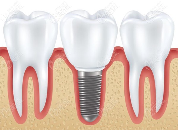 廣州圣貝做進(jìn)口種植牙的補(bǔ)貼福利 廣州圣貝做進(jìn)口種植牙的補(bǔ)貼福利