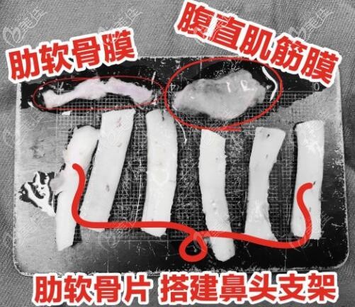 自體筋膜墊鼻尖可選擇的材料