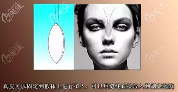 自體真皮隆鼻材料