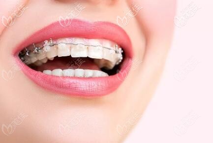 陶瓷半隱形矯正 陶瓷半隱形矯正