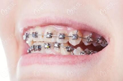 金屬鋼牙套 金屬鋼牙套