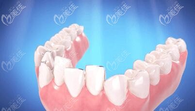 無托槽隱形矯治 無托槽隱形矯治