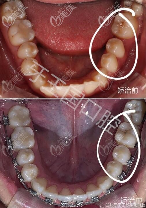 缺牙智齒牽引成功啦,金屬自鎖托槽矯正歷時(shí)1年半關(guān)閉間隙